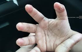 Secara bahasa ya'juj & ma'juj dari bahsa arab, kata ya'juj mempunyai turunan kata ujaaj yang berarti. Cara Merawat Anak Terkena Hfmd
