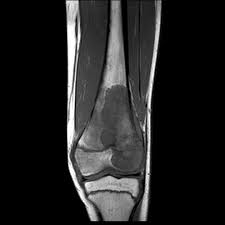 Delaying surgery with chemotherapy for osteosarcoma of the extremities. Osteosarcoma Distal Femur Radiology Case Radiopaedia Org