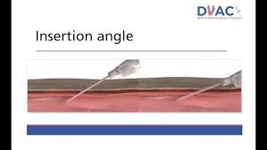 Image result for Difficult Intravenous Access in Children