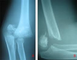 Through bone cyst stress fractures stress fx. Children Distal Humerus Supracondylar Fractures The Blount Method Experience Sciencedirect