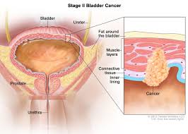 If the bladder tumor invades into the urethra, it can block urine flow and cause straining to urinate. Bladder Cancer Treatment Bladder Cancer Pictures Signs Symptoms To Better Understand Diagnosis Cleveland Oh University Hospitals