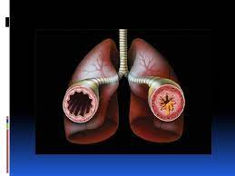 Aminimmums Ac Ir Asthma And Pregnancy Case History