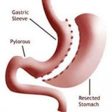 Bariatric Surgery And The Sleeve Sleeve Surgery Gastric Sleeve Sleeve Gastrectomy