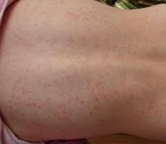 Globalhealthtip Sore Throat And Rash Strep Infection And Other Causes
