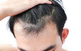 The scalp produces two types of hair growth and deterioration, james notes. Prp For Hair Loss Can It Reverse Baldness Without Surgery Pills Or Creams Plastic Surgery Ut Southwestern Medical Center