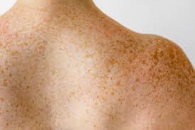 Image result for Freckled skin