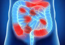 Der stuhl ist entweder verfärbt oder zeigt blutauflagerungen. Colitis Ulcerosa Www Takeda Gastroenterologie De