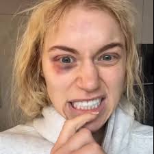 Elle Brooke shares black and swollen eye as she tells fans she still looks  cute - Daily Star