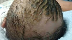 It is characterized by rough, scaly patches on the symptoms of cradle cap include greasy patches of skin, yellow or white scales, thick crusty flakes, red and irritated skin as well as hair loss. Cradle Cap Leading Hair Loss Pic Included Babycenter