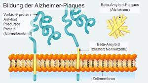Check spelling or type a new query. Alzheimer Eiweissablagerungen Im Gehirn Als Ursache