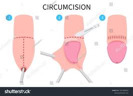 Image result for paraphimosis