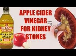 Very Easy Ways To Use Apple Cider Vinegar For Kidney Stones Youtube Treat Kidney Stones Kidney Stones Apple Cider Vinegar