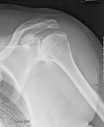 Shoulder And Elbow Surgery Bone Spurs And Shoulder Replacement Surgery Bone Spurs Shoulder Replacement Surgery Shoulder Surgery