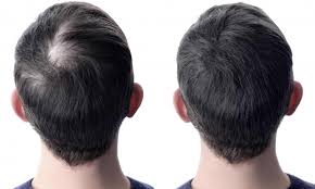 زراعة الشعر الأحدث وبدون جراحة dr bayer clinics