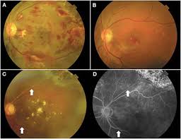 Image result for HIV Retinitis