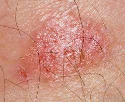 Susceptible fungi and yeast include. What Is Ketoconazole With Pictures