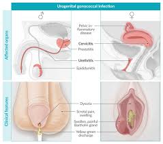 Image result for gonorrhea symptoms