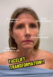 “I feel like my face drooped over the past 3 years and I just wanted to  look like myself just refreshed. Dr. Kassir you truly are an artist and  made me look 20 years younger! I can not thank you ...