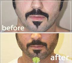 Facial hair transplant in india. Hair Transplant Results See Before After Photos