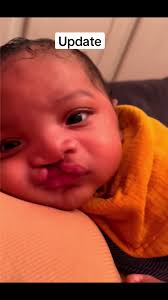 Kaleb Torres from Shriners Hospital