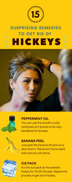 15 Home Remedies How To Get Rid Of A Hickey Fast And Overnight How To Hide Hickeys Natural Acne Remedies Home Remedies For Acne