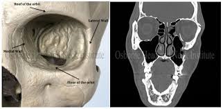 Derrick Rose Orbital Fracture Surgery Derrick Rose Plastic And Reconstructive Surgery Head And Neck