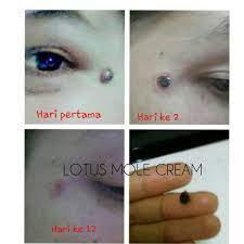 Tahi lalat yang tumbuh pada bayi baru lahir biasanya berukuran lebih besar, dan dapat tersebar di. Beauty Cara Buang Tahi Lalat Kutil Ketuat Pundi Minyak Dan Isi Terlebih Farah Dafri