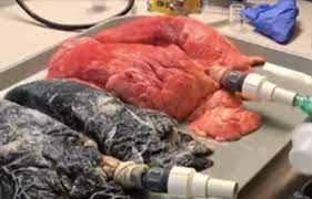 Cancerul pulmonar ( cancerul la plamani) este un tip de cancer ce debuteaza in zona plamanilor. Cancerul Pulmonar In Randul NefumÄƒtorilor Mai Frecvent Decat Se Crede