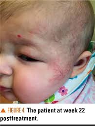 It is the most common type of angioma. Segmental Hemangioma On A Newborn S Face