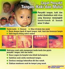 Penyakit kuku dan mulut memang lebih sering menyerang anak dengan usia kurang dari 5 tahun. Kenyataan Akhbar Kpk 16 Jun 2016 Situasi Semasa Penyakit Tangan Kaki Dan Mulut Hfmd Di Malaysia From The Desk Of The Director General Of Health Malaysia