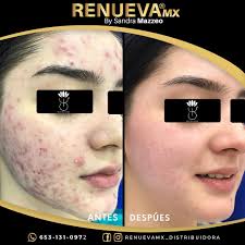 Renueva MX by Sandra Mazzeo (@renuevamx_distribuidora) • Instagram photos  and videos