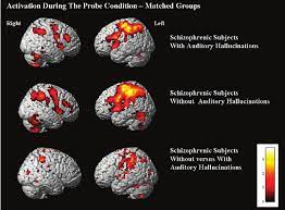Schizophrenia is a serious mental disorder in which people interpret reality abnormally. Activation Probe Condition For Matched Schizophrenic Groups Download Scientific Diagram