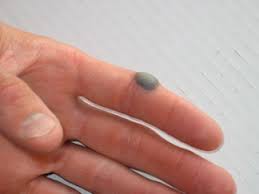 Precautions to take with blood blisters never break the skin around the blood blister; Blood Blisters Causes Treatment Study Com