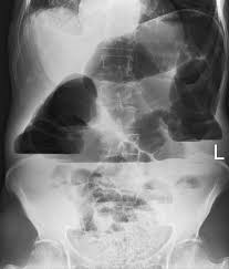 Common lifestyle risk factors for fi may include: Fecal Impaction Radiology Reference Article Radiopaedia Org