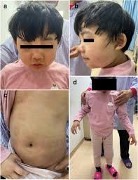 A de novo heterozygous variant in ACOX1 gene cause Mitchell syndrome: the  first case in China and literature review
