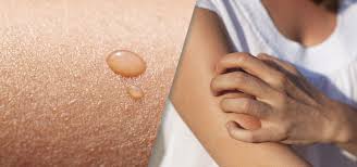 Image result for Ichthyosis