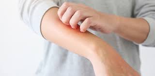 The rashes tended to appear in younger people and lasted. 8 Ways The Coronavirus Can Affect Your Skin From Covid Toes To Rashes And Hair Loss Bond University