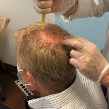 The vampire hair treatment isolates the magic from your blood. Prp Hair Loss And Restoration Treatment Darrow Stem Cell Institute