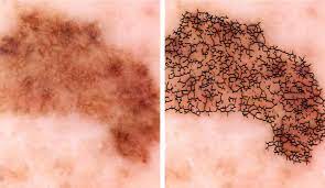 A diagnosis of lung cancer naturally causes some overwhelming emotions, but you don't have to let those emotions get the best of you. Researchers Develop Automated Melanoma Detector For Skin Cancer Screening