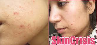Pil kb yasmin memiliki bentuk sediaan berupa tablet salut selaput atau biasa disebut juga pil. Help Ik Heb Puistjes Beautylab Nl