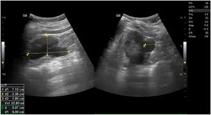 Image result for Perinephric Abscess