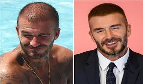 David Beckham Saç Ekimi