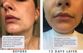 How long is the purge? How To Get Rid Of Sudden Acne Breakouts That Come Out Of Nowhere