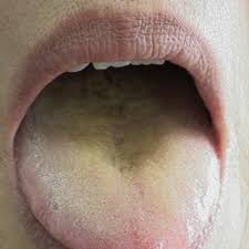 舌苔黄腻_百度百科