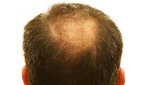 This is a dht hair loss cure. New Hair Loss Cure Baseline Of Health Foundation