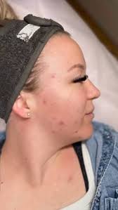 Even as a nurse and a skin therapist