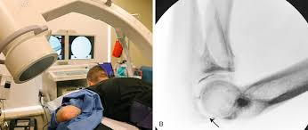 Image result for Elbow Joint Injection