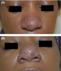 Check spelling or type a new query. Improvement In Lupus Pernio With The Successive Use Of Pulsed Dye Laser And Nonablative Fractional Resurfacing Semantic Scholar