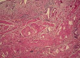 The Bladder Histopathology Of Ketamine Cystitis The Lamina Propria Download Scientific Diagram