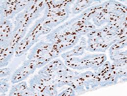Most cases of lung cancer are associated with. Duct Papilloma Origin Human Papillomavirus 52 Positive Squamous Cell Carcinoma Of The Conjunctiva